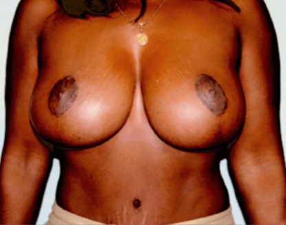 San Diego Mastopexy After