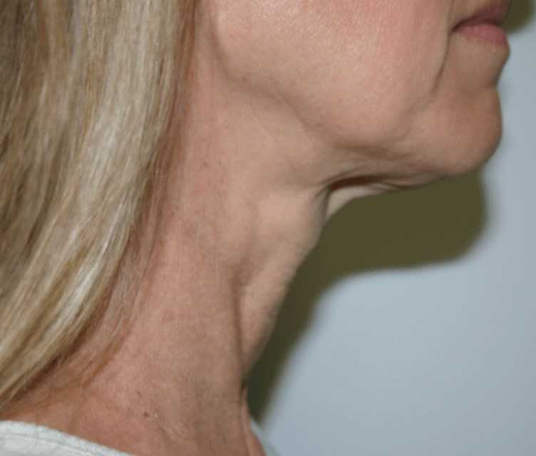 San Diego Platysmaplasty Before