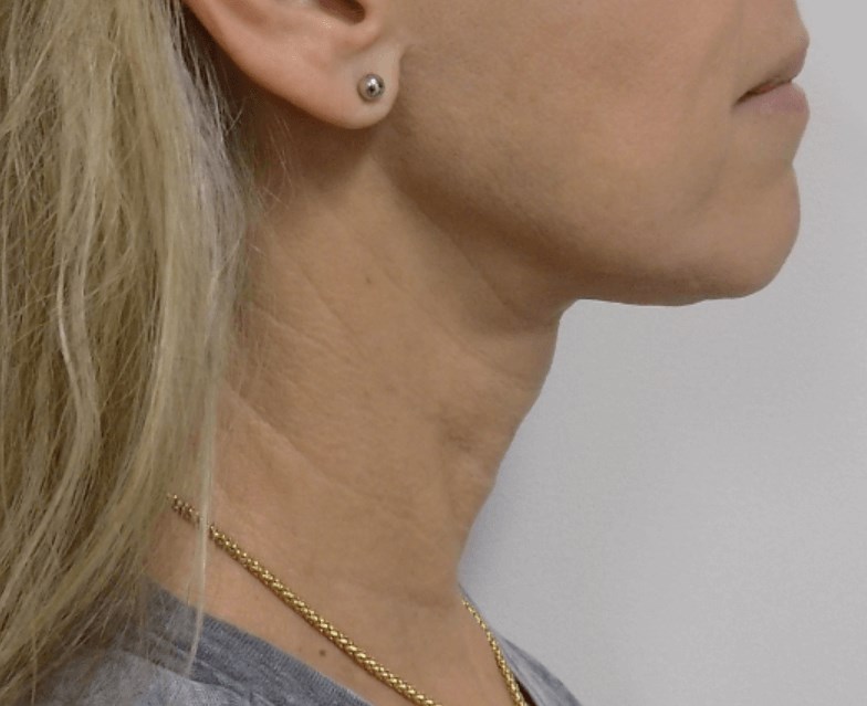 San Diego Platysmaplasty After