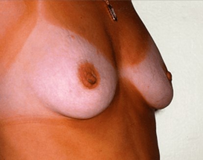 San Diego Breast Enhancement Before