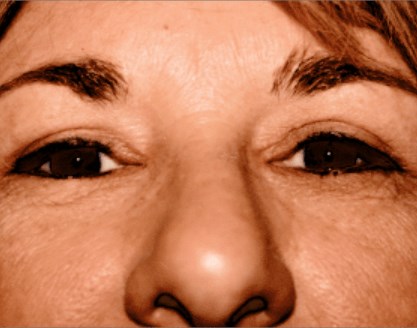 San Diego Upper Eyelid Lift After