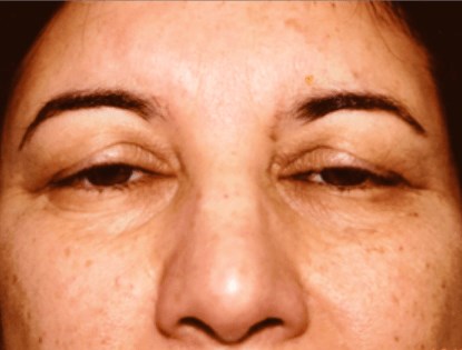San Diego Upper Blepharoplasty Before