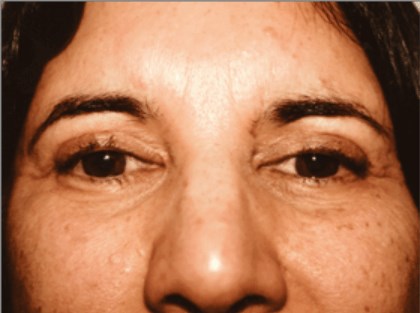 San Diego Upper Blepharoplasty After