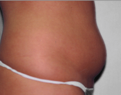 San Diego Liposuction Before