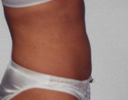 San Diego Liposuction After