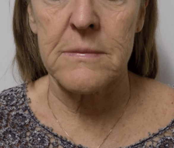 San Diego Face and Neck Lift Before