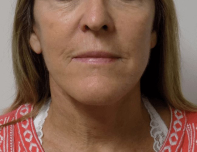San Diego Face and Neck Lift After