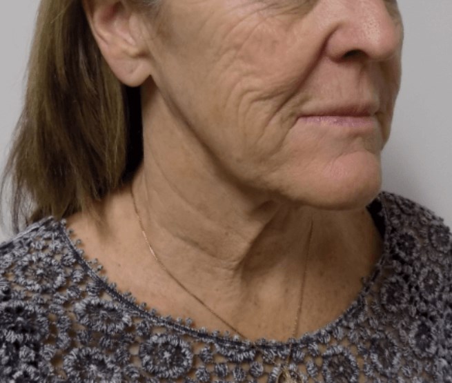 San Diego Face and Neck Lift Before