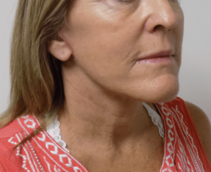 San Diego Face and Neck Lift After