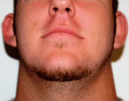 San Diego Otoplasty Before