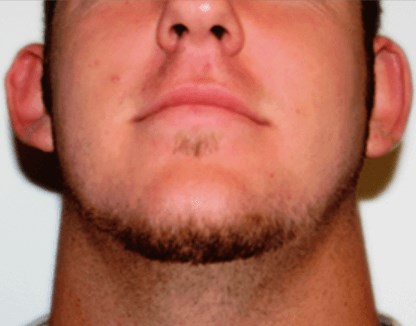 San Diego Otoplasty Before