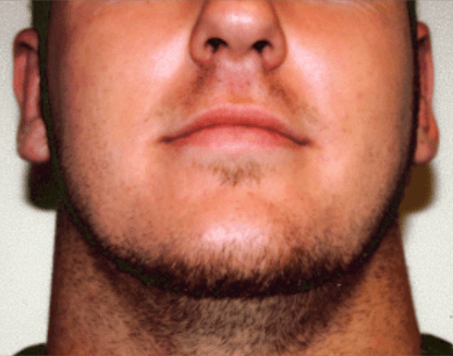 San Diego Otoplasty After