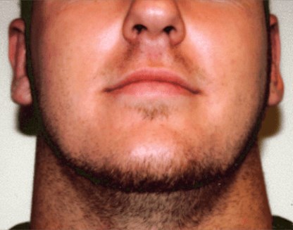 San Diego Otoplasty After