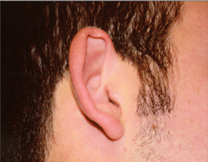 San Diego Otoplasty Before