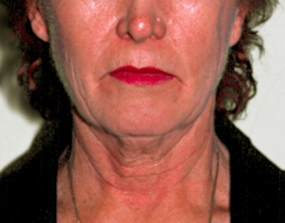 La Mesa Face & Neck Lift Before