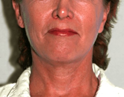 La Mesa Face & Neck Lift After