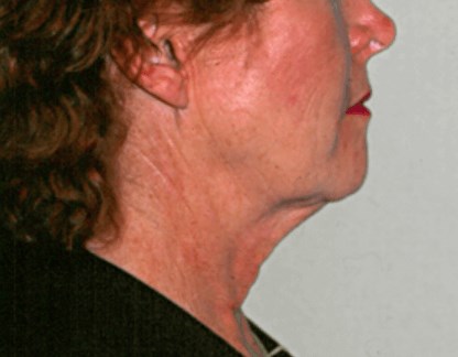 La Mesa Face & Neck Lift Before