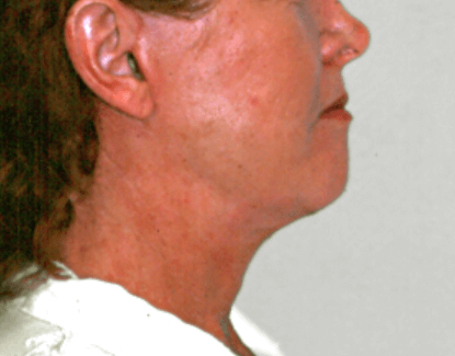 La Mesa Face & Neck Lift After