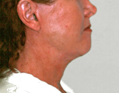 La Mesa Face & Neck Lift After