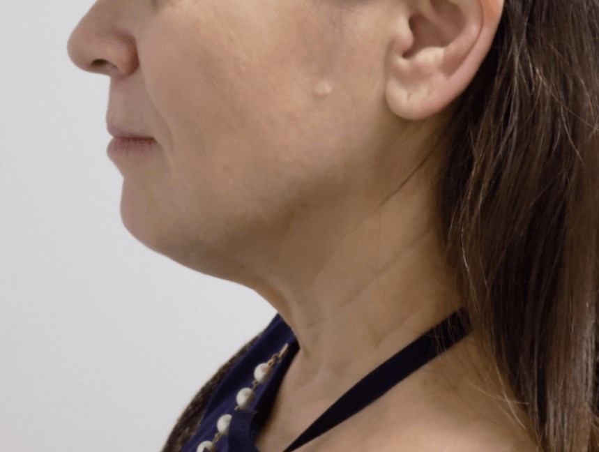 La Mesa Face & Neck Surgery Before