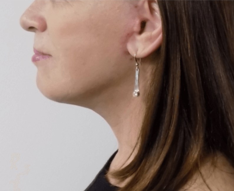 La Mesa Face & Neck Surgery After