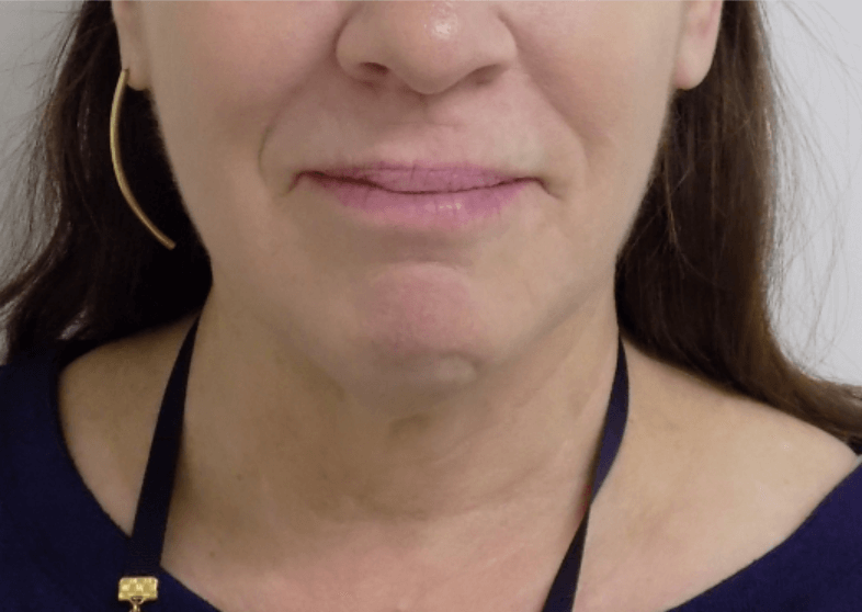 La Mesa Face & Neck Surgery Before