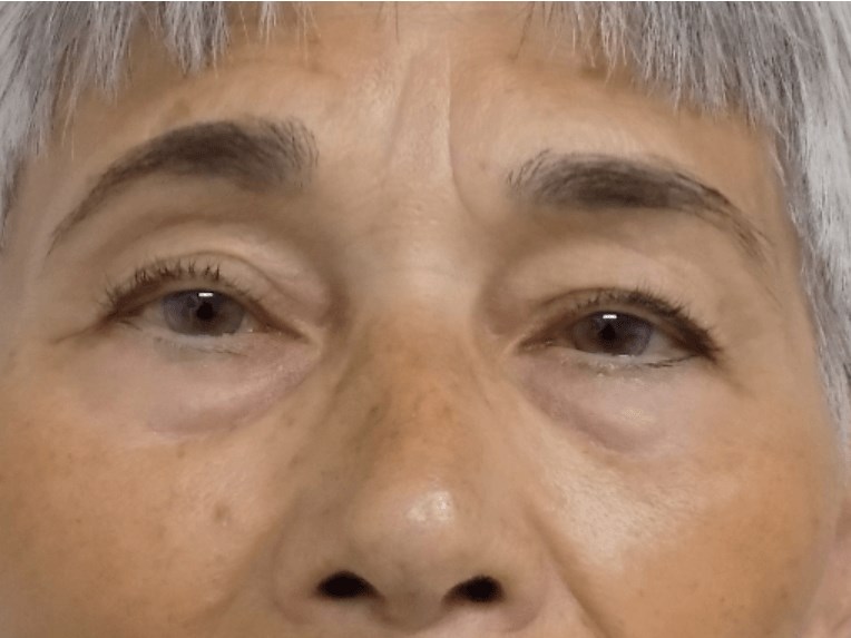 La Mesa Eyelid Lift Before