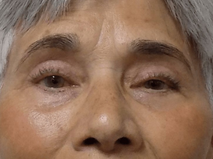 La Mesa Eyelid Lift After