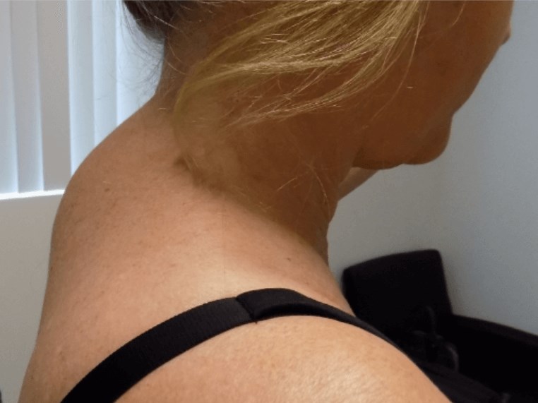 San Diego Buffalo Hump Before