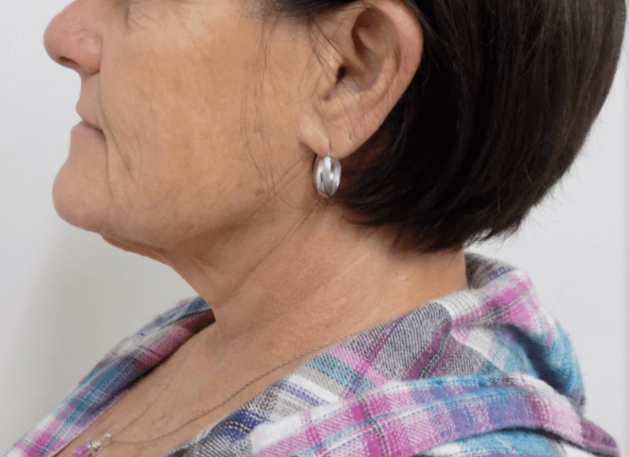 La Mesa Neck Lift Before