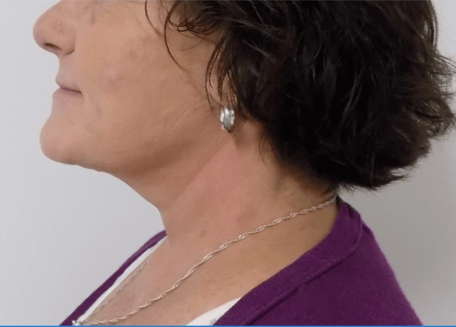 La Mesa Neck Lift After