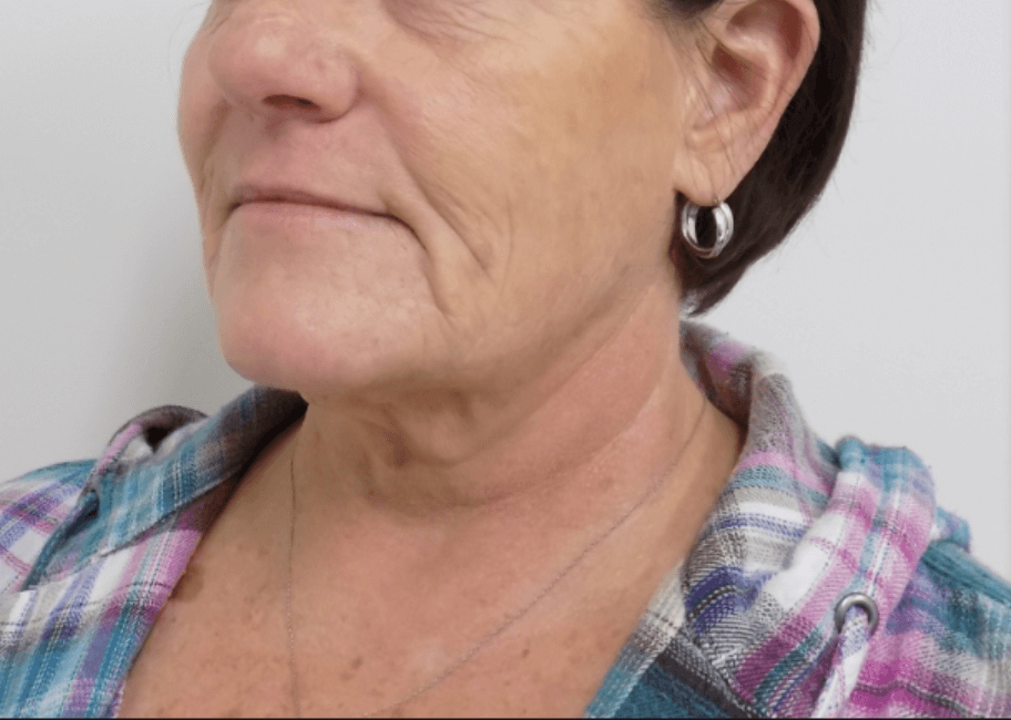 La Mesa Neck Lift Before