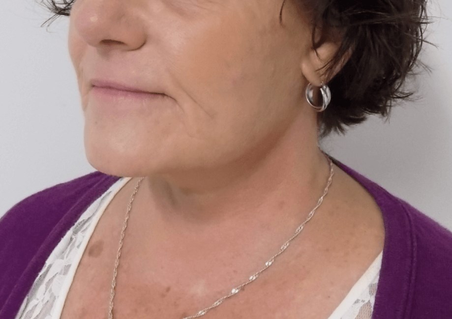 La Mesa Neck Lift After