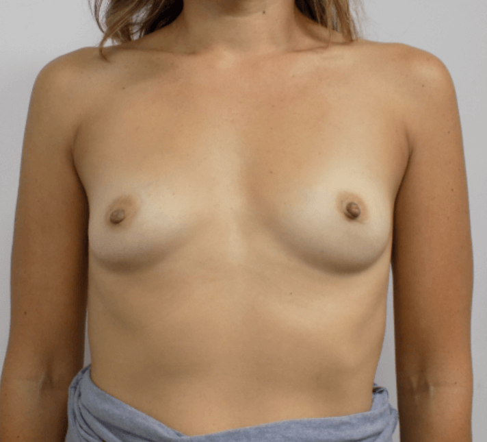 San Diego Breast Augmentation Before