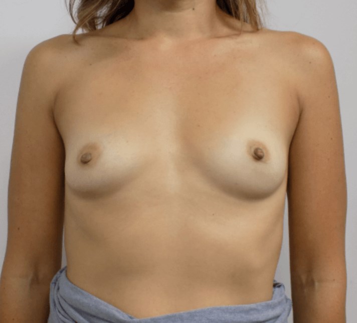 San Diego Breast Augmentation Before