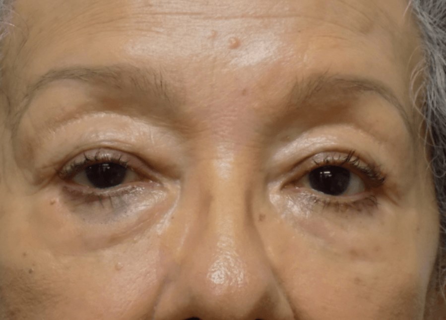 La Mesa Quad Blepharoplasty Before
