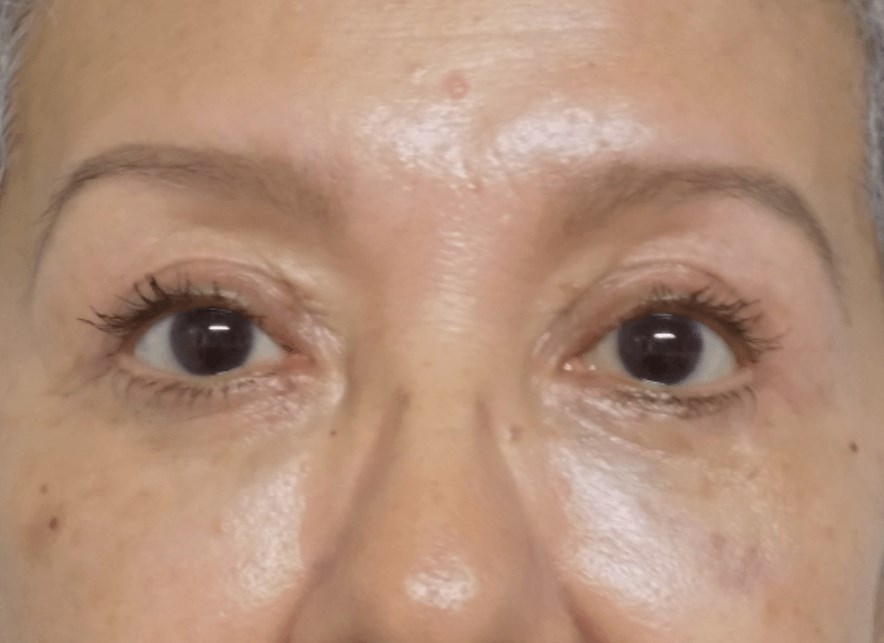 La Mesa Quad Blepharoplasty After