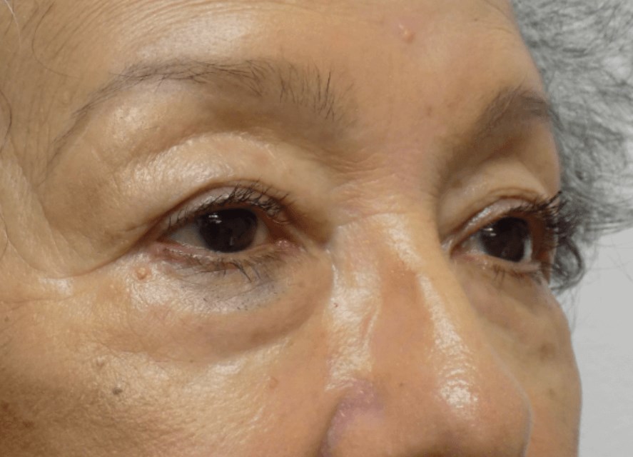 La Mesa Quad Blepharoplasty Before