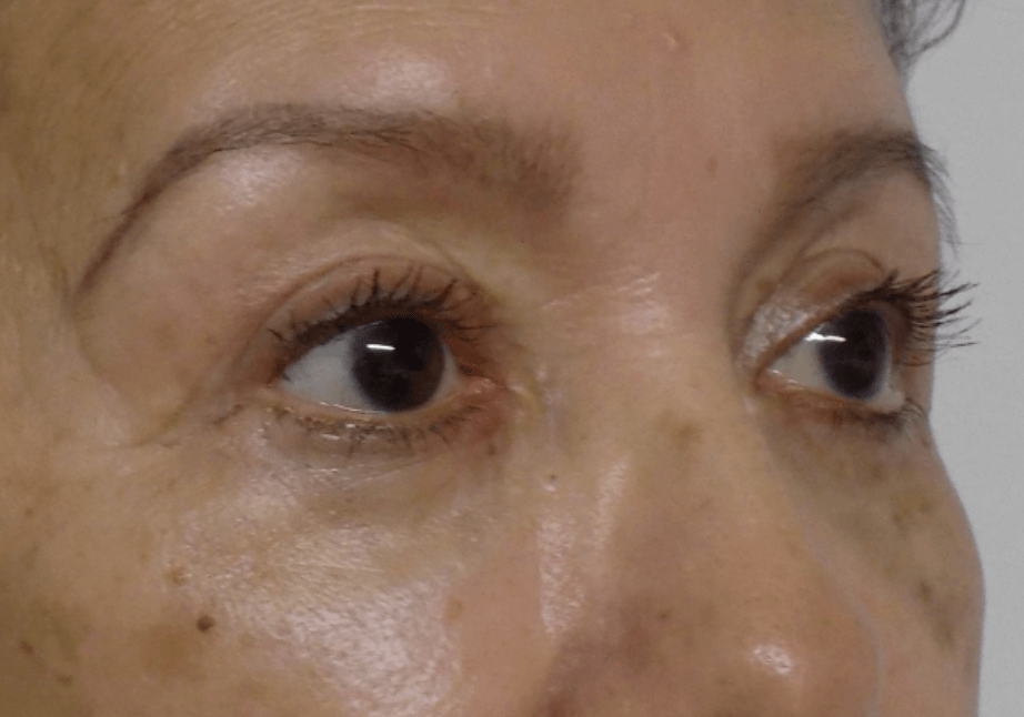 La Mesa Quad Blepharoplasty After