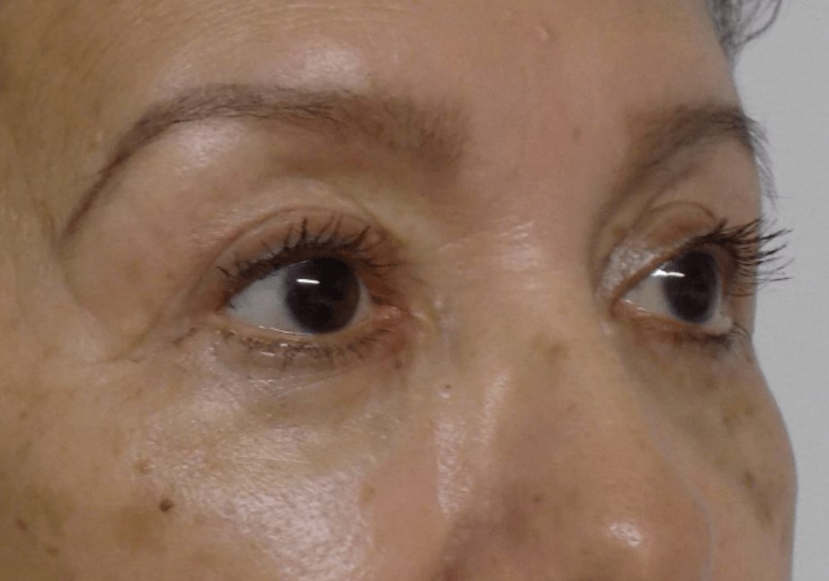 La Mesa Quad Blepharoplasty After