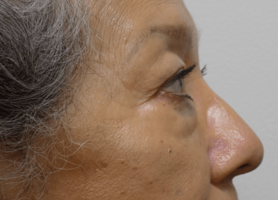 La Mesa Quad Blepharoplasty Before