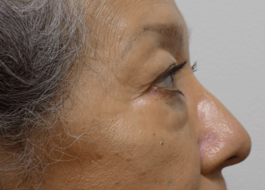 La Mesa Quad Blepharoplasty Before