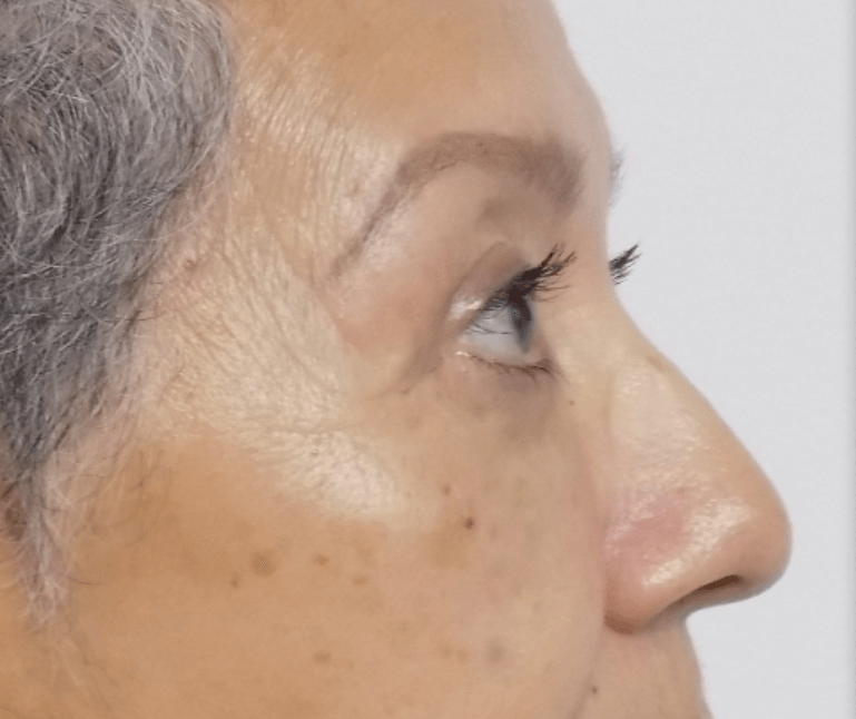 La Mesa Quad Blepharoplasty After