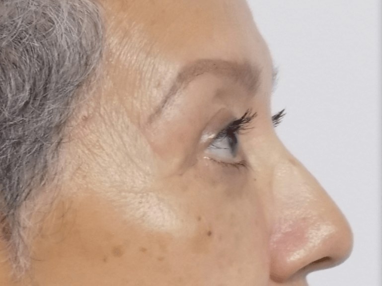 La Mesa Quad Blepharoplasty After