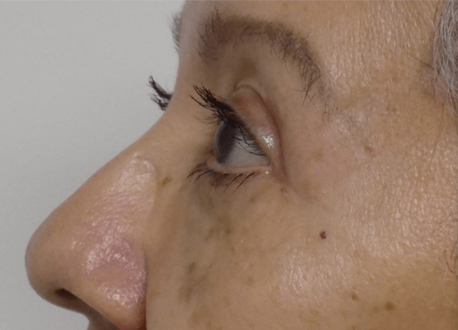 La Mesa Quad Blepharoplasty After