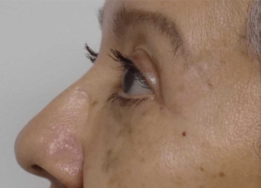 La Mesa Quad Blepharoplasty After