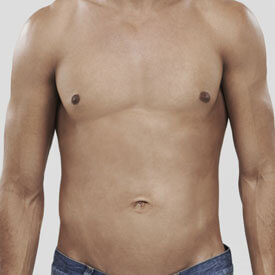 Gynecomastia 
